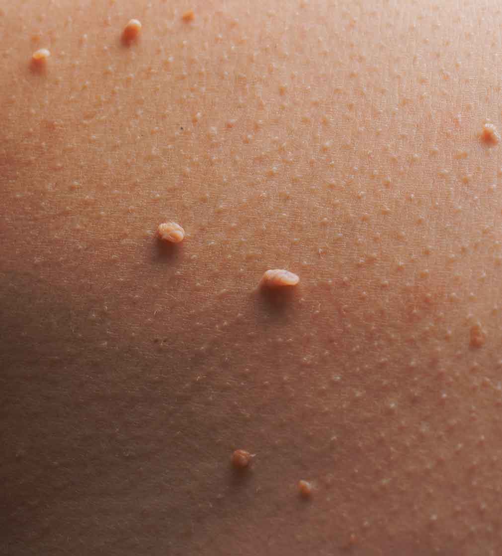 skin tags and warts