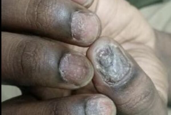 nail psoriasis pune