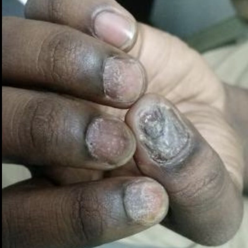 nail psoriasis pune