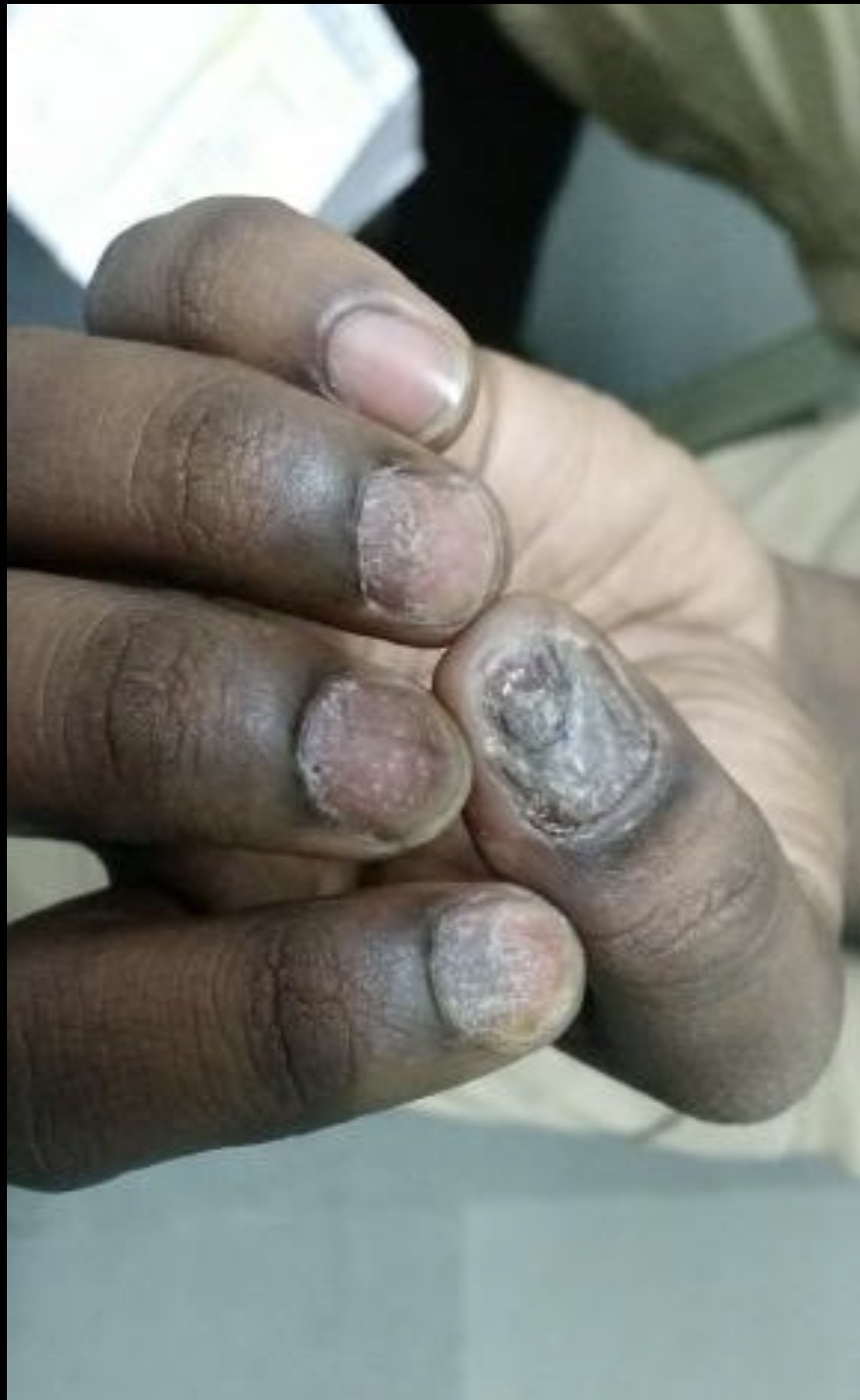 nail psoriasis pune