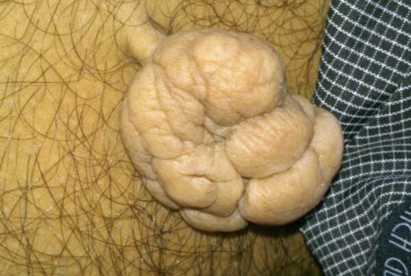 skin tag removal pune