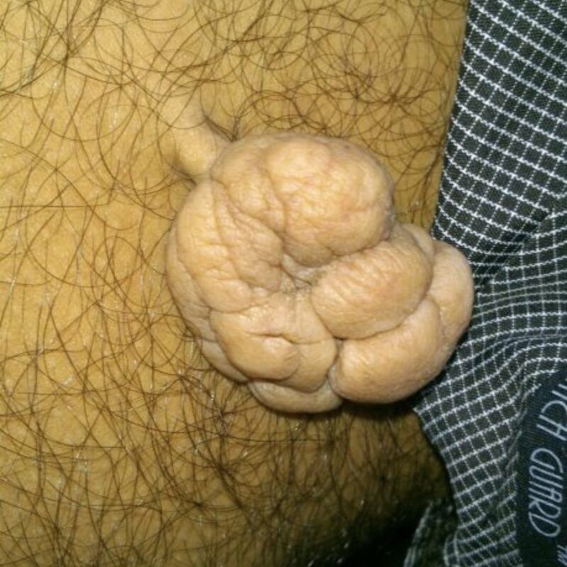 skin tag removal pune