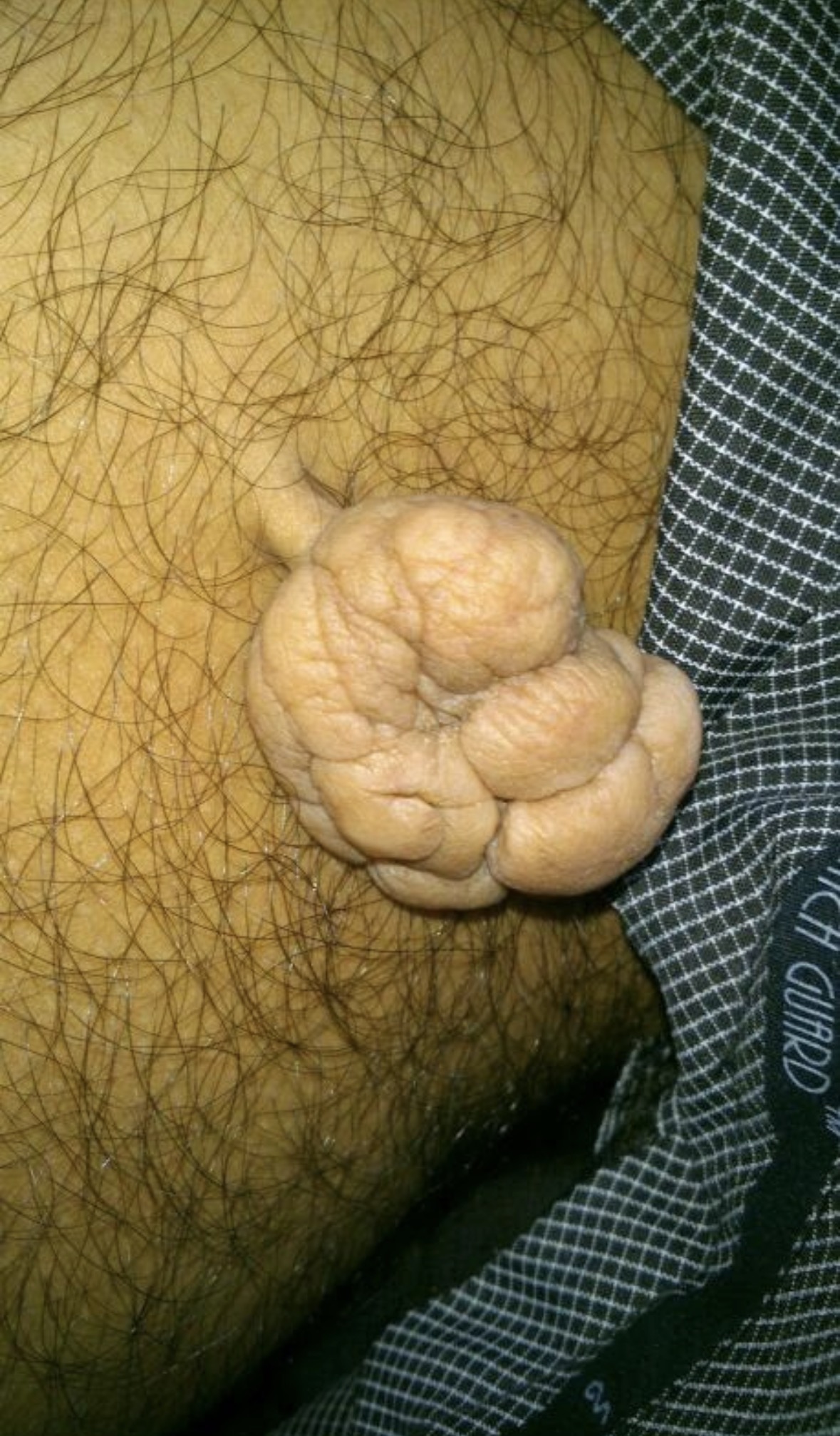 skin tag removal pune