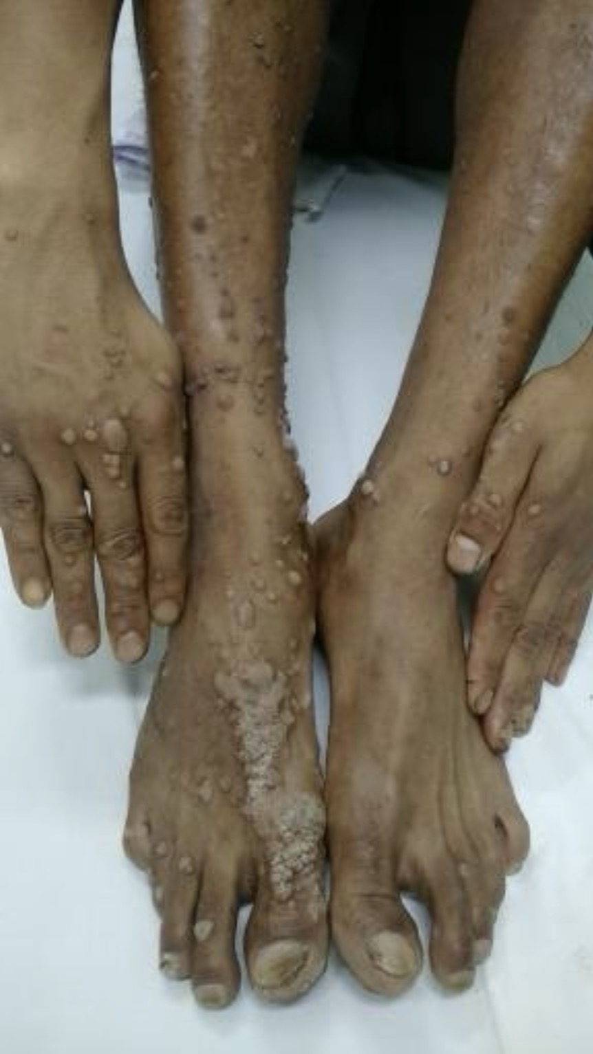 warts on hands feet 