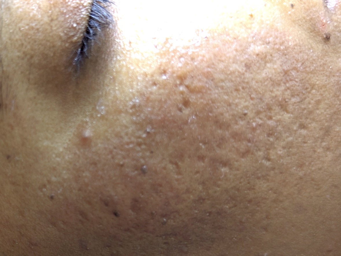 ice pick scars