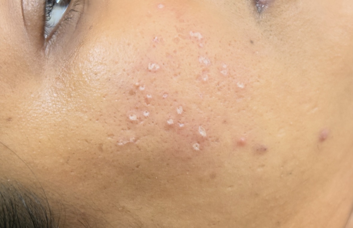 Acne scar pune